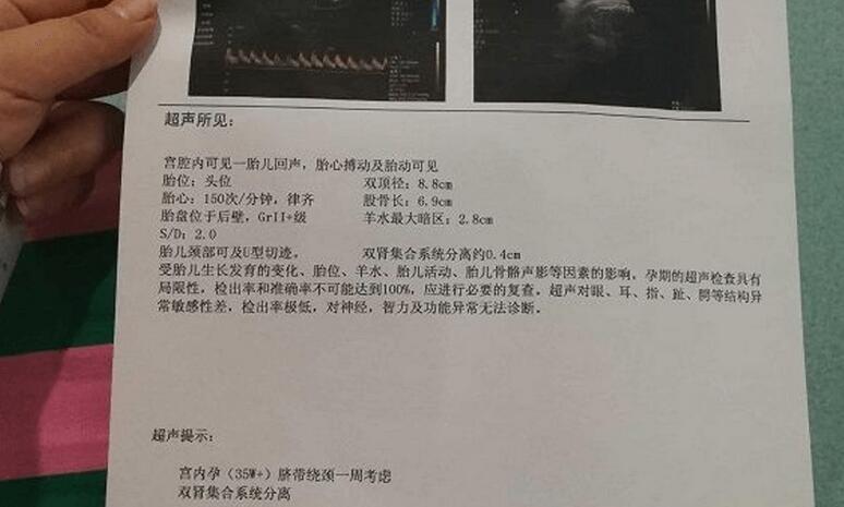 羊水指数新标准详解，25cm指南解读