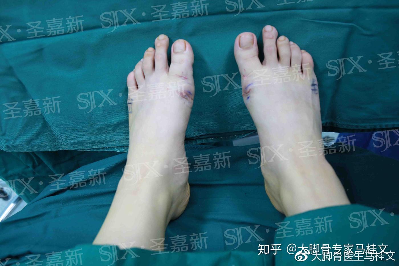 脚拇指外翻最新治疗新方法,脚拇指外翻最新治疗新方法👣告别疼痛，重拾自信步伐！